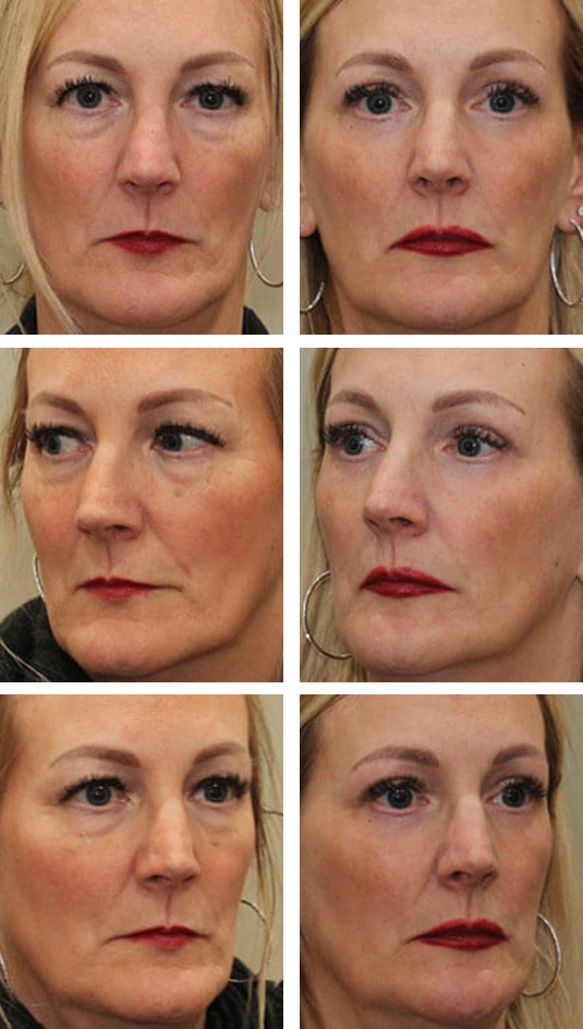  Before and After Picture 
51 year old female – upper blepharoplasty, transconjunctival lower blepharoplasty, periocular fractional CO2 laser skin resurfacing.