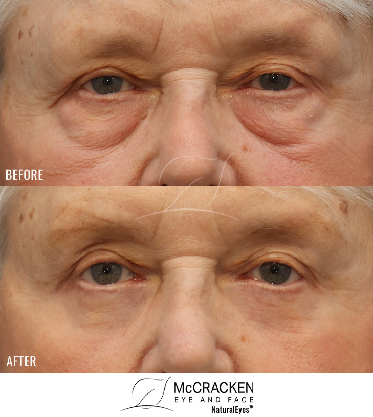 76 Year Old Female – Lower Lid Blepharoplasty with Fat Repositioning and Laser Skin Resurfacing. No Lower Lid Skin Incisions were made.