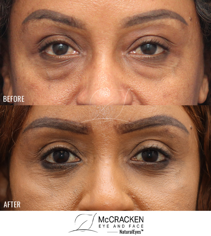 42 Year Old Female – Lower Lid Blepharoplasty with Bilateral Lower lid AccuTite Skin Tightening. No Lower Lid Skin Incisions were made.
