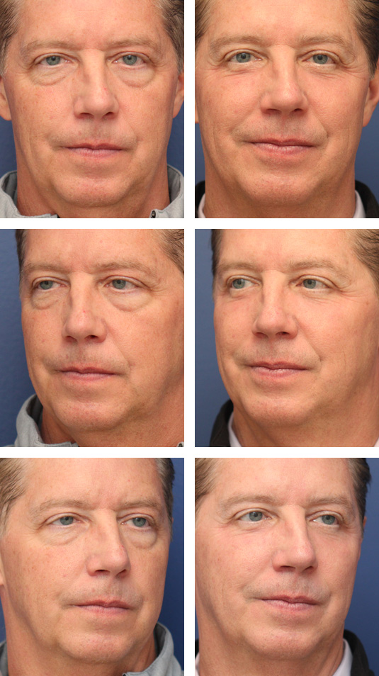  Before and After Picture 
52 Year Old Male – Upper and Lower Blepharoplasty with Laser Skin Resurfacing. No lower lid skin incisions were made.