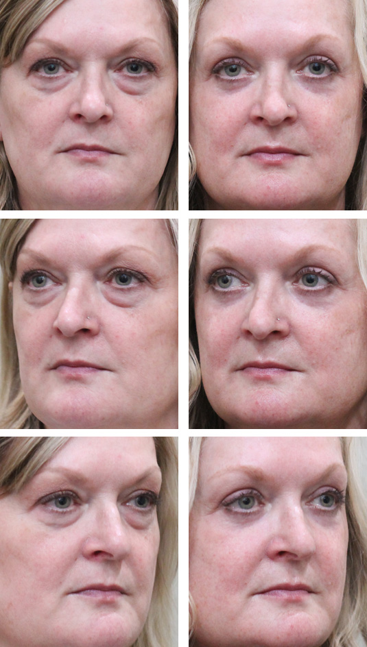  Before and After Picture 
53 Year Old Female – Upper blepharoplasty, Transconjunctival Lower Blepharoplasty, Periocular Fractional CO2 Laser Skin Resurfacing.