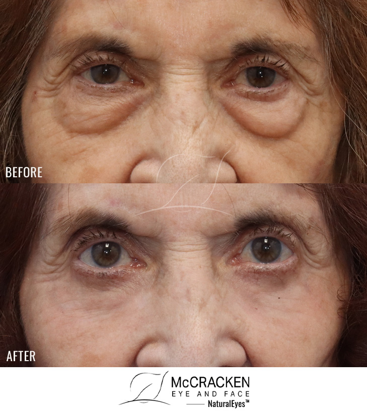 86 Year Old Female – Upper and Lower Blepharoplasty (with Lower Lid Skin Excision) with Fat Injection (5cc on the Right and 6cc on the Left) and Periocular Laser Skin Resurfacing.