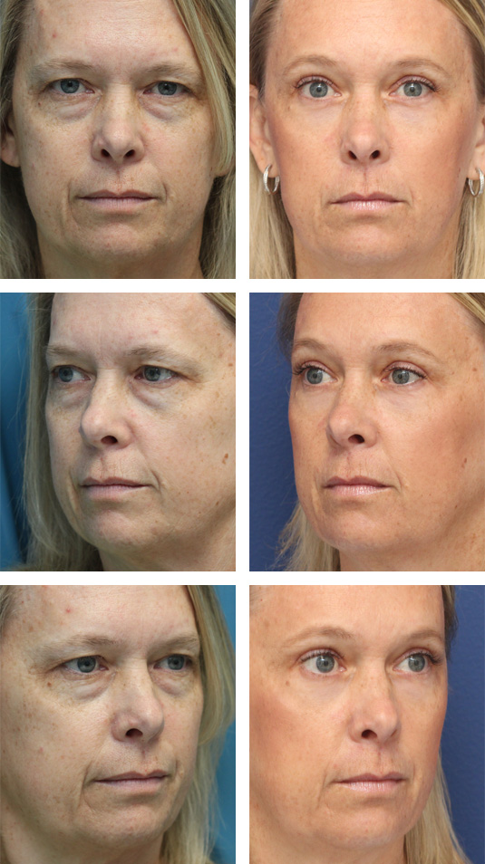  Before and After Picture 
54 Year Old Female – Endoscopic Brow Lift with Upper and Lower Blepharoplasty and laser skin resurfacing.  The brow lift was fixated with EndoTines.  No lower lid skin incisions were made.
