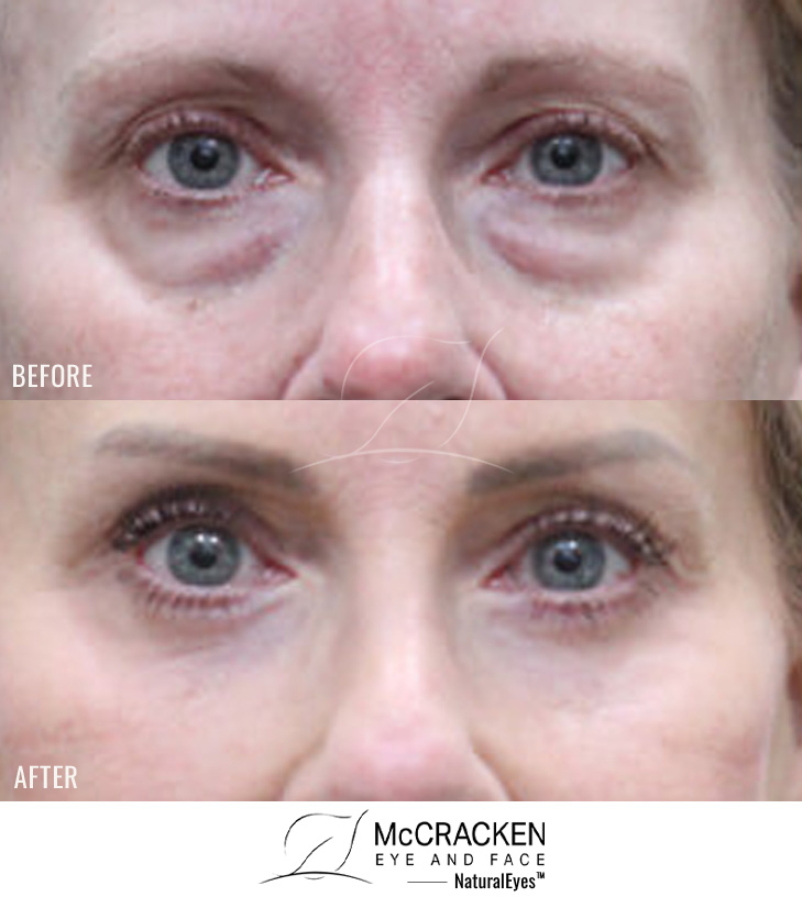 60 Year Old Female – Upper and Lower Blepharoplasty with Laser Skin Resurfacing. No Skin Incisions.