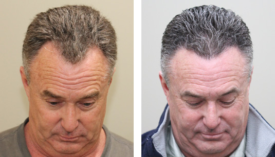  Before and After Picture  
55 Year Old Male, 6 Months s/p 1400 Grafts to the Hairline