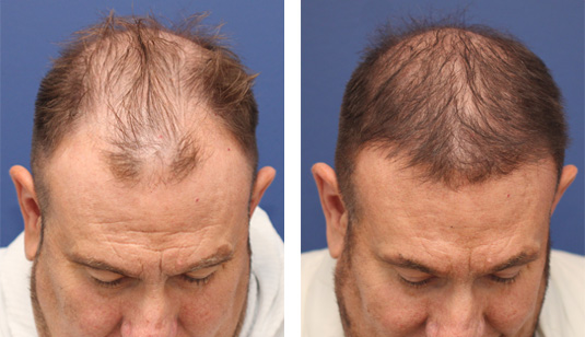  Before and After Picture 
55 year old male, 7 months after 2701 grafts to the hairline and top of the scalp.
