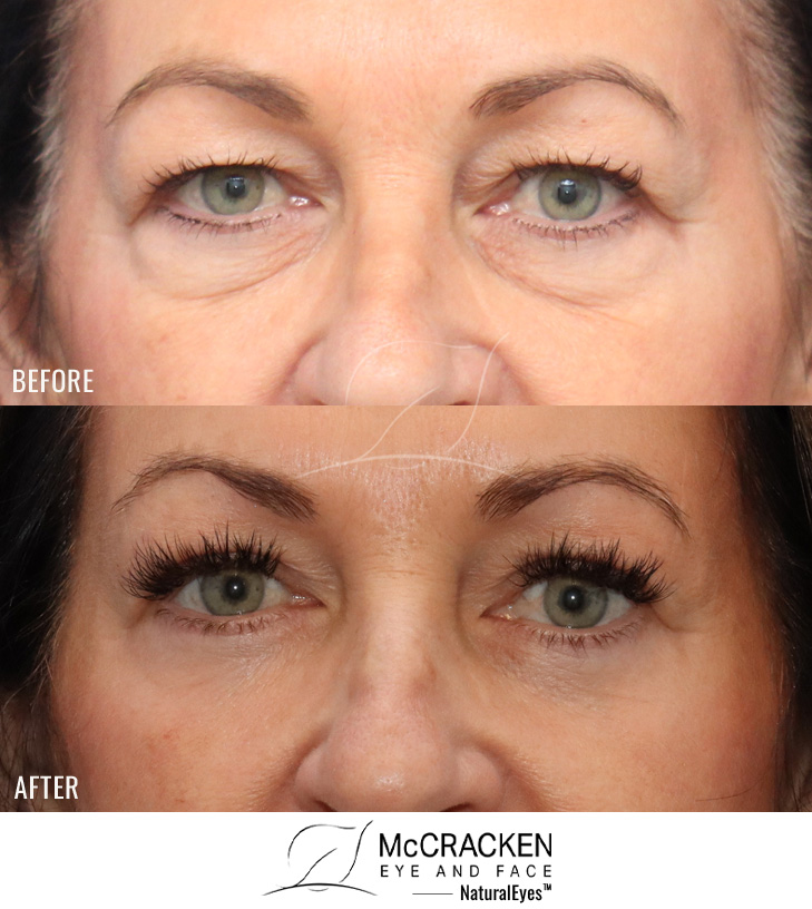 57 Year Old Female – Upper and Lower Blepharoplasty with Periocular Laser Skin Resurfacing. No lower lid skin incisions were made.