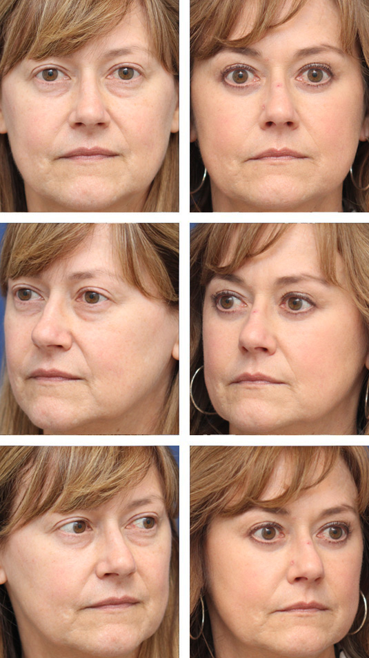  Before and After Picture 
56 Year Old Female – Lower Blepharoplasty with Periocular Laser Skin Resurfacing. No lower lid skin incisions were made.