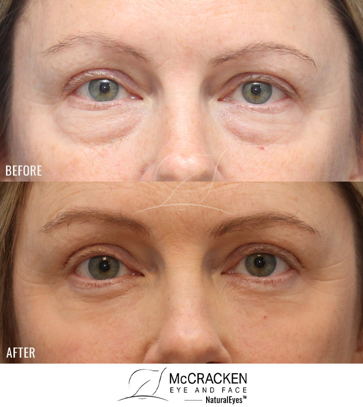 48 Year Old Female – Lower Blepharoplasty with Periocular Laser Skin Resurfacing. No lower lid skin incisions were made.