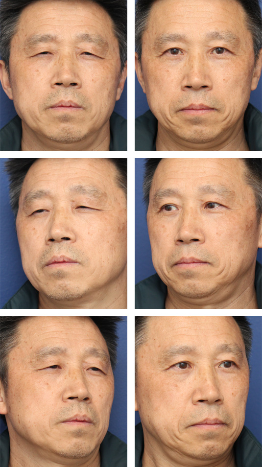  Before and After Picture 
57 Year Old Male – Upper Blepharoplasty