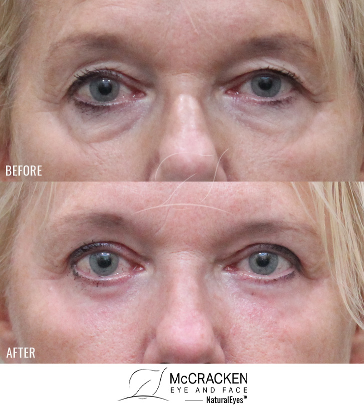 62 Year Old Female – Upper and Lower Blepharoplasty with Periocular Laser Skin Resurfacing. No lower lid skin incisions were made.