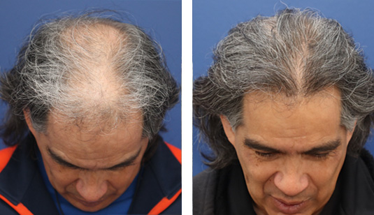 Before and After Picture
58 year old male, 1 year after FUE transplant; 2500 grafts to the hairline and midscalp. Before and After Picture
58 year old male, 1 year after FUE transplant; 2500 grafts to the hairline and midscalp.