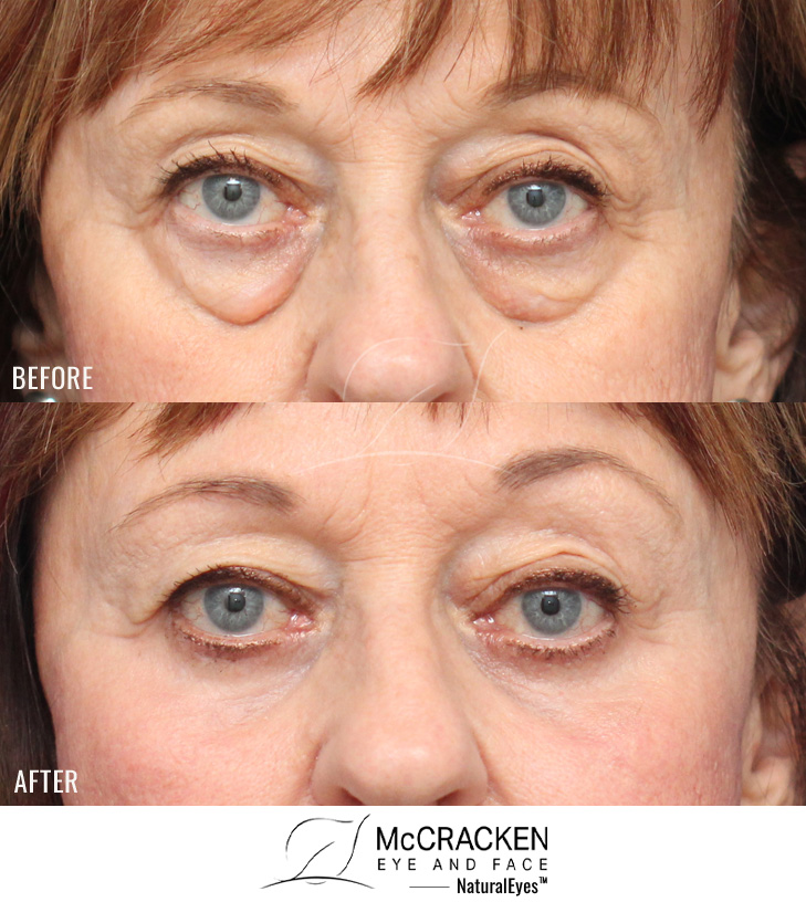 72 Year Old Female – Mid-Facelift with Lower Blepharoplasty and Periocular Laser Skin Resurfacing. The mid-facelift was performed through incisions in the mouth and temples, without any skin incisions. The lower lid blepharoplasty was performed through an incision on the inside of the eyelid with a small strip of skin excision under the lashes.