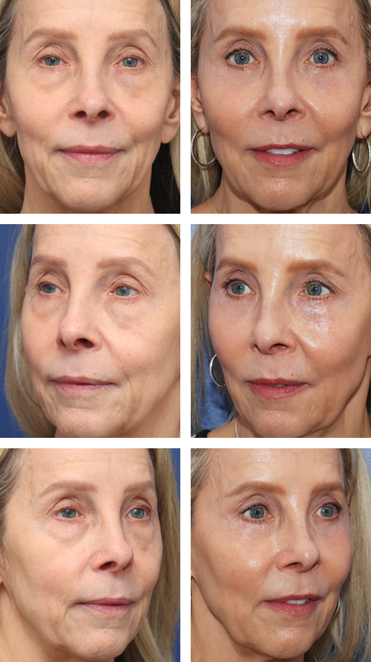  Before and After Picture 
59 Year Old Female – Bilateral Upper Lid Ptosis Repair, Bilateral Lower Lid Blepharoplasty Injection of 5cc of Fat to Each Cheek, and Laser Skin Resurfacing. No Lower Lid Skin Incisions were made.