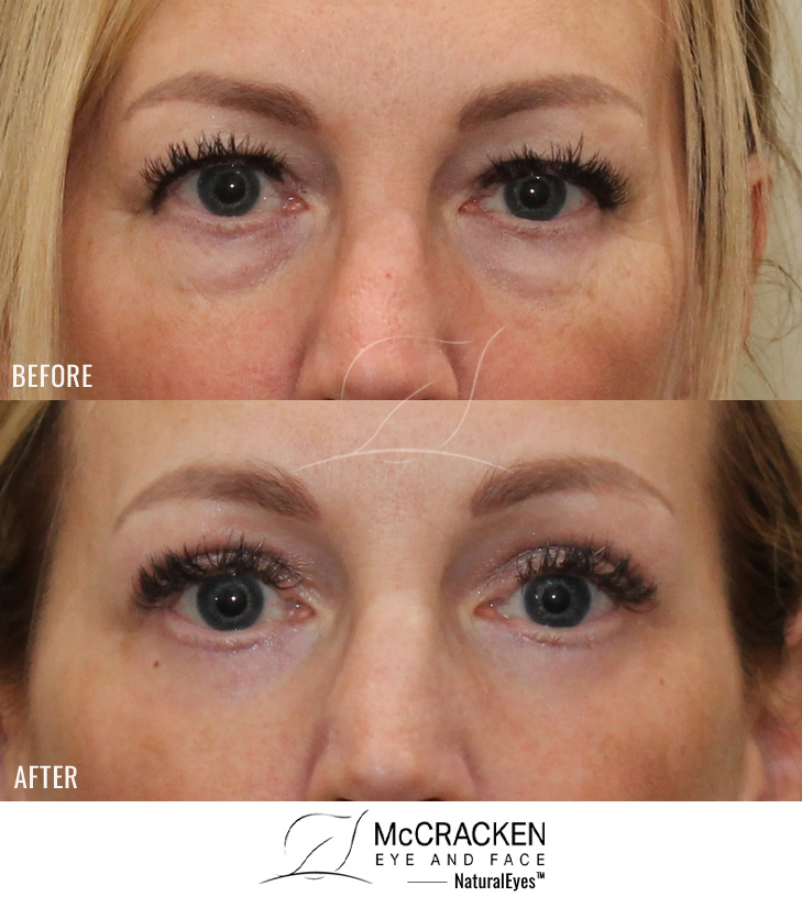 51 year old female – upper blepharoplasty, transconjunctival lower blepharoplasty, periocular fractional CO2 laser skin resurfacing.