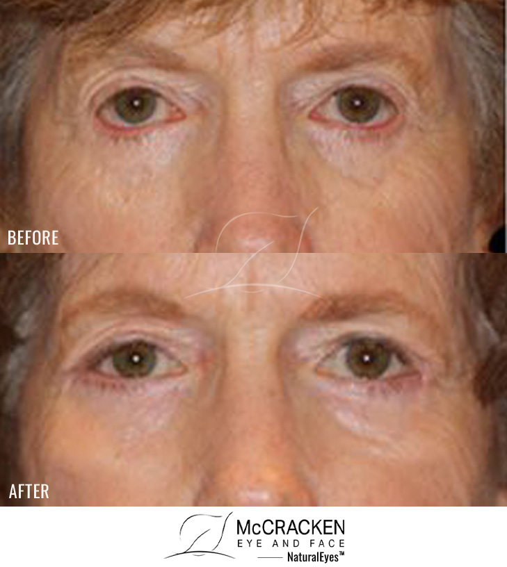 77 Year Old Female – Repair of Lower Lid Retraction After Unsatisfactory Blepharoplasty