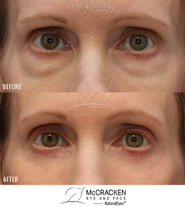 49 Year Old Female Lower Lid Blepharoplasty with Fat Repositioning, Injection of 4cc of Fat to Each Cheek and Laser Skin Resurfacing. No Lower Lid Skin Incisions were made.