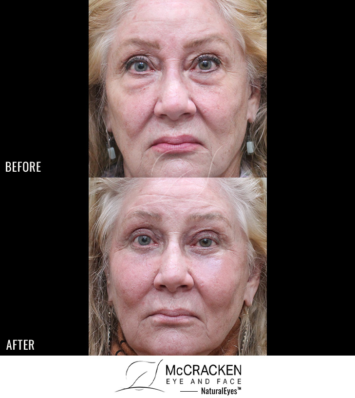 67 Year Old Female – Bilateral Upper and Lower Blepharoplasty with Endoscopic Midface Lift and Periocular Laser Skin Resurfacing.