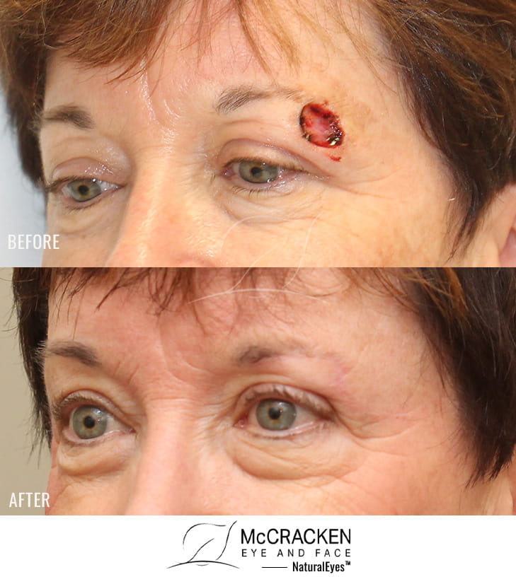 54 year old female – repair of left upper lid and brow defect after Mohs excision of basal cell carcinoma.