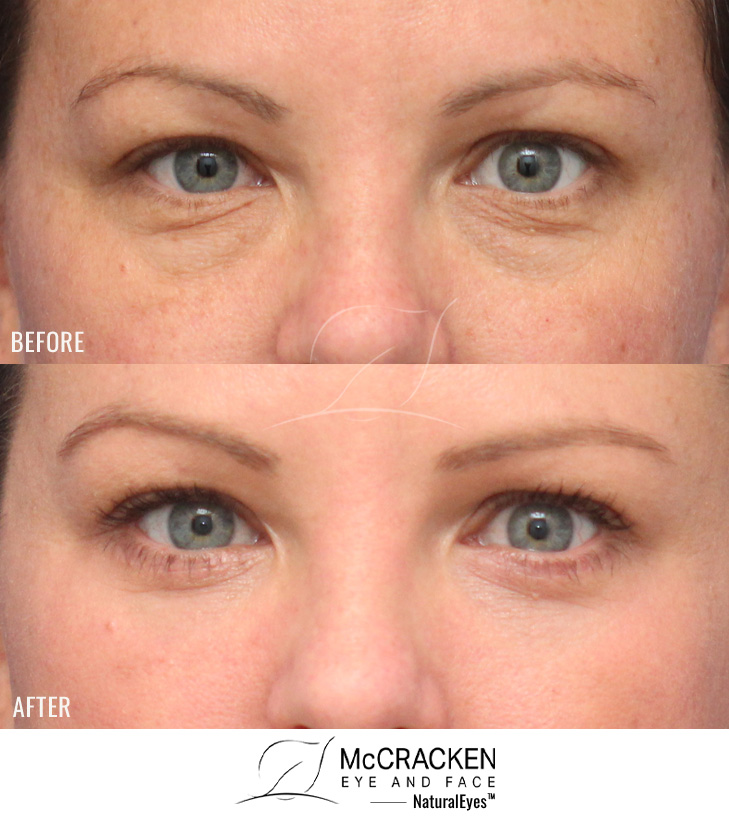 38 Year Old Female – Lower Blepharoplasty with Periocular Laser Skin Resurfacing. A small strip of lower lid skin was excised.