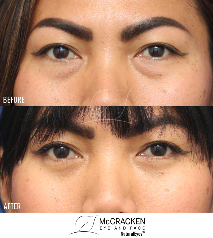 39 Year Old Female – Lower Blepharoplasty With Fat Repositioning. No skin incisions were made.