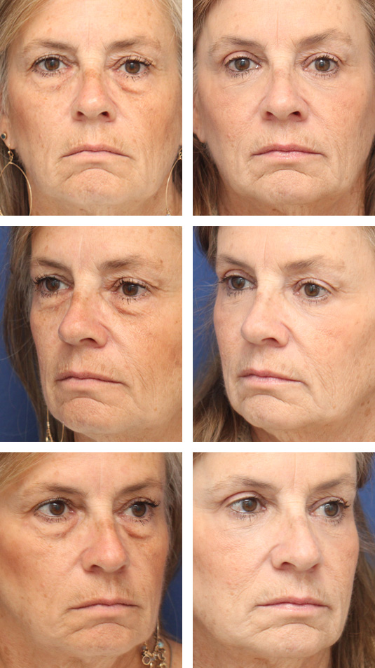  Before and After Picture 
62 Year Old Female – Upper and Lower Lid Blepharoplasty with Injection of 4cc of Fat to Each Cheek, and Laser Skin Resurfacing. 
