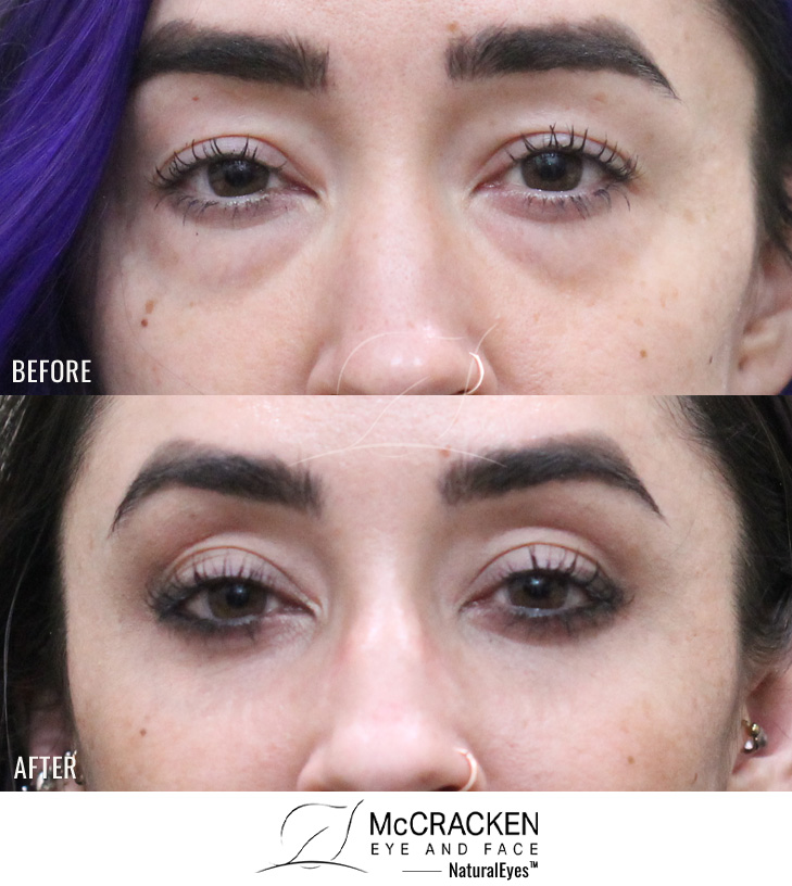 29 Year Old Female – Lower Blepharoplasty and Periocular Laser Skin Resurfacing. No Skin Incisions.