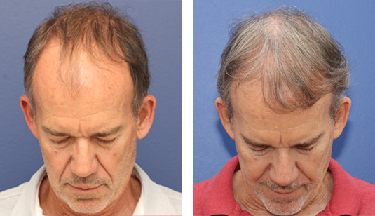  Before and After Picture 
63 year old male, 1 year after FUE transplant; 2816 grafts to the hairline and crown.