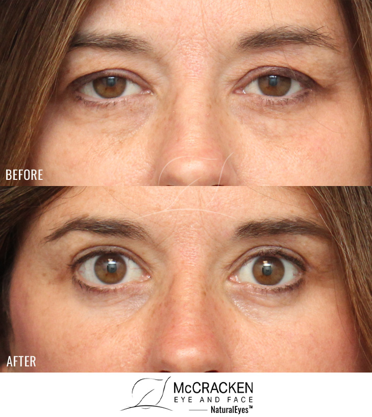 45 Year Old Female – Upper and Lower Blepharoplasty with Periocular Laser Skin Resurfacing and Bilateral Upper Lid Ptosis Repair (tightening of the lid lifting muscle). No lower lid skin incisions were made.