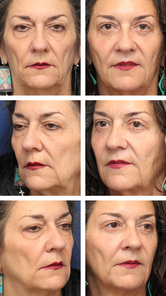  Before and After Picture 
63 Year Old Female – Bilateral Upper lid Blepharoplasty and Bilateral Upper Lid Ptosis Repair with Bilateral Lower Blepharoplasty via Skin Muscle Flap Excision.