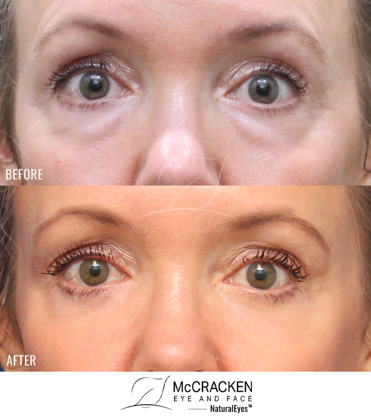 50 Year Old Female – Upper and Lower Blepharoplasty with Periocular Laser Skin Resurfacing. No lower lid skin incisions were made.