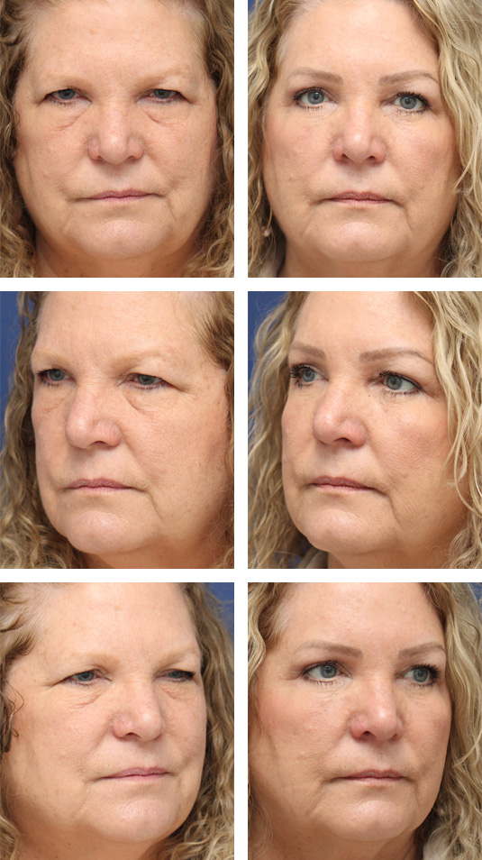  Before and After Picture 
65 Year Old Female – Bilateral Endoscopic Brow Lift with Upper and Lower Lid Blepharoplasty with Laser Skin Resurfacing.  The brow lift was fixated with EndoTines and the lower lid blepharoplasty was performed with a skin muscle flap.