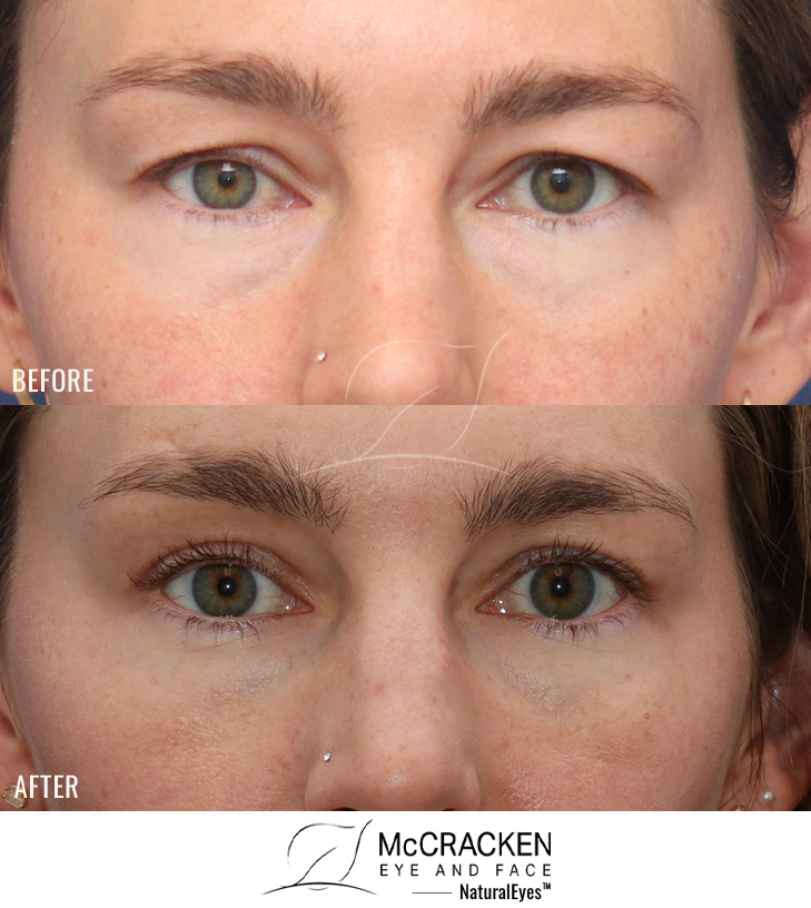 37 Year Old Female – Upper Blepharoplasty with Right Upper Lid Ptosis Repair