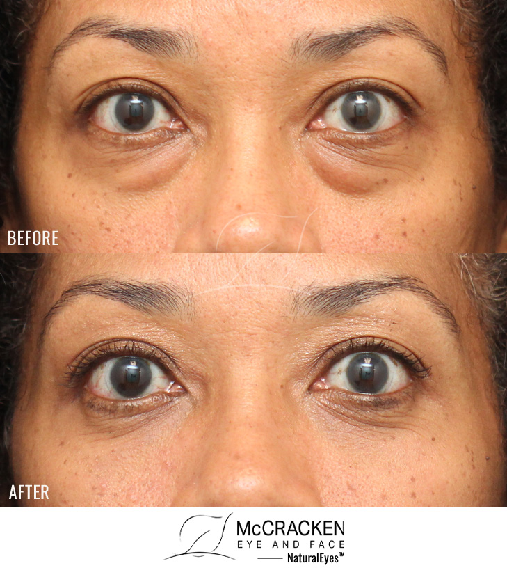 49 Year Old Female – Upper and Lower Blepharoplasty. No lower lid skin incisions were made.