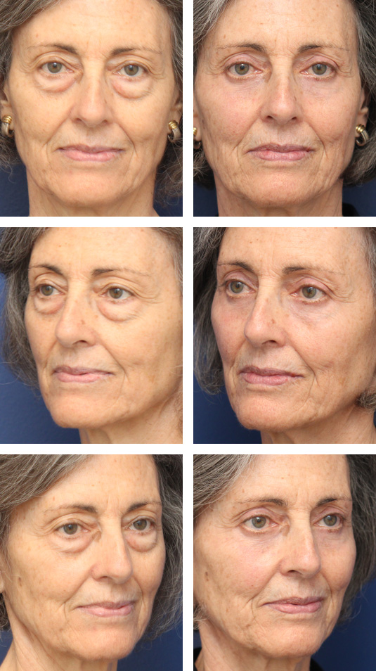  Before and After Picture 
67 Year Old Female – Upper and Lower Lid Blepharoplasty with Injection of 2.5cc of Fat to Each Cheek and Laser Skin Resurfacing. No Lower Lid Skin Incisions were made.