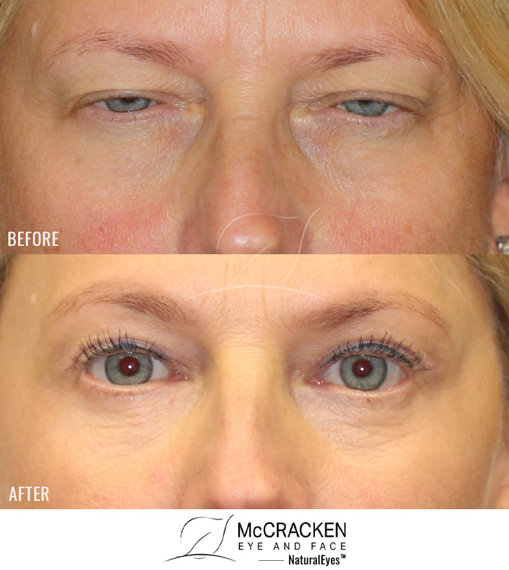 54 Year Old Female – Brow Lift, Upper and Lower Blepharoplasty, and Periocular Laser Skin Resurfacing