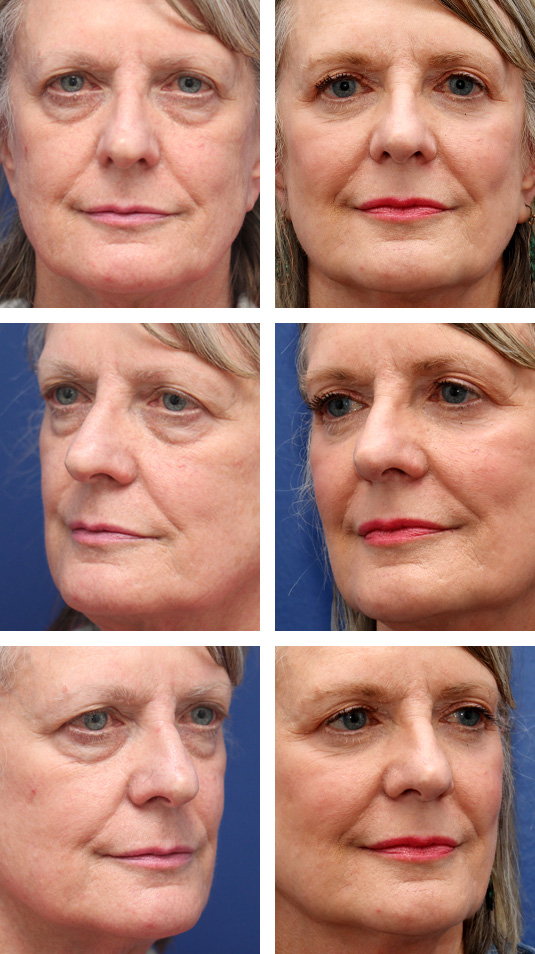  Before and After Picture 
68 Year Old Female – Lower Lid Blepharoplasty with Fat Repositioning, Injection of 4cc of Fat to Each Cheek, and Laser Skin Resurfacing. No Lower Lid Skin Incisions were made.