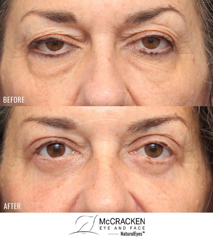 63 Year Old Female – Bilateral Upper lid Blepharoplasty and Bilateral Upper Lid Ptosis Repair with Bilateral Lower Blepharoplasty via Skin Muscle Flap Excision.