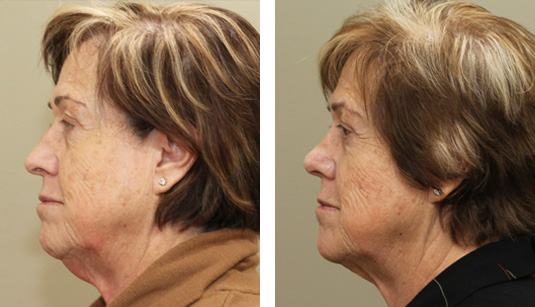  Before and After Picture  
69 year old Female - Kybella (2 treatments)
