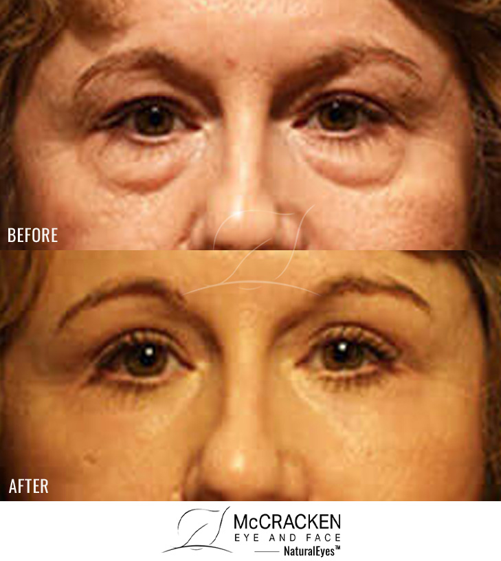 44 Year Old Female – Upper and Lower Blepharoplasty with Full Face Laser Resurfacing