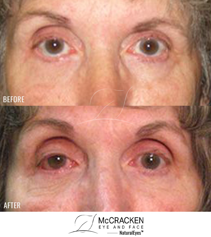 64 Year Old Female – Repair of Lower Lid Retraction After Unsatisfactory Blepharoplasty