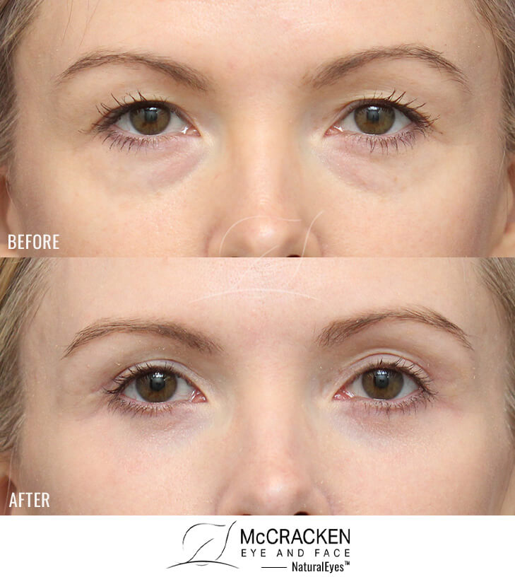 36 Year Old Female Upper and Lower Blepharoplasty with Periocular Laser Skin Resurfacing. No lower lid skin incisions were made.