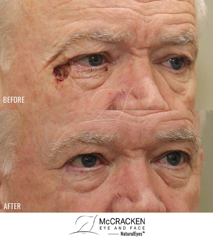 72 year old male – Repair of right lateral canthal defect after excision of basal cell carcinoma.