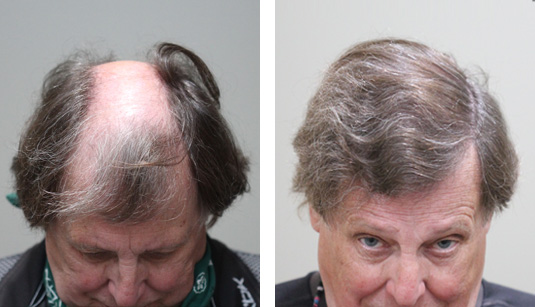  Before and After Picture 
70 year old male, 1 year after 2895 grafts.