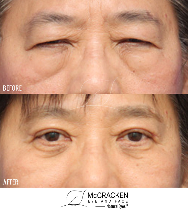 43 Year Old Female – Upper and Lower Lid Blepharoplasty with Injection of 4cc of Fat to Each Cheek. No Lower Lid Skin Incisions were made, and lower lid fat was excised and repositioned.