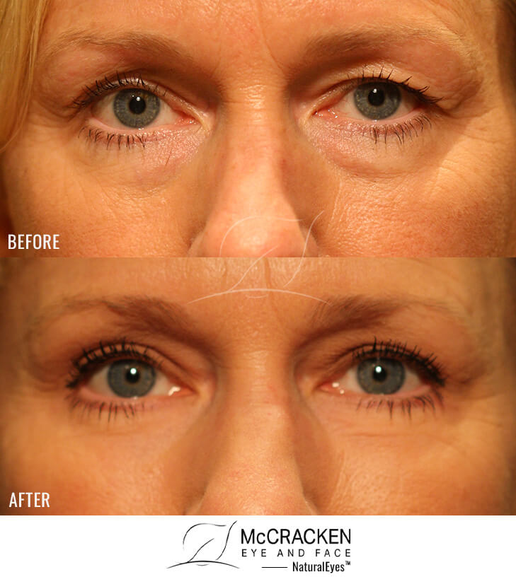45 Year Old Female – Upper and Lower Blephaorplasty with Periocular Laser Skin Resurfacing