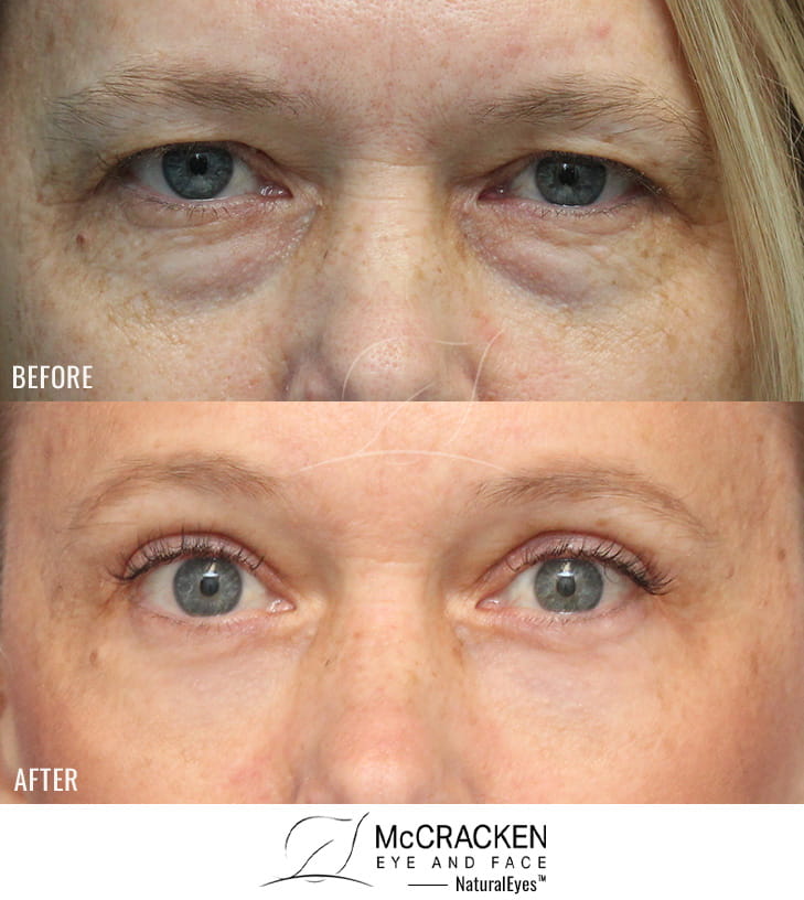 54 Year Old Female – Endoscopic Brow Lift with Upper and Lower Blepharoplasty and laser skin resurfacing. The brow lift was fixated with EndoTines. No lower lid skin incisions were made.