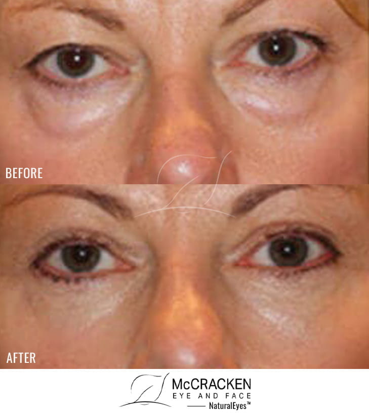 56 Year Old Female – Upper and Lower Blepharoplasty