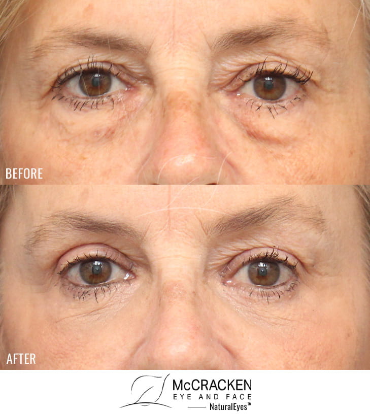 62 Year Old Female – Upper and Lower Lid Blepharoplasty with Injection of 4cc of Fat to Each Cheek, and Laser Skin Resurfacing.
