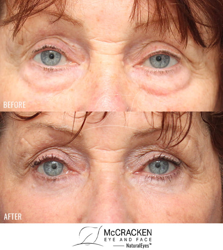 71 Year Old Female – Lower Blepharoplasty with Periocular Laser Skin Resurfacing. No lower lid skin incisions were made.